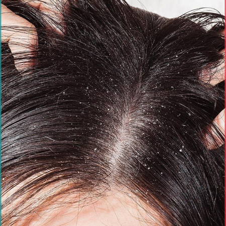 Dandruff & Flakes