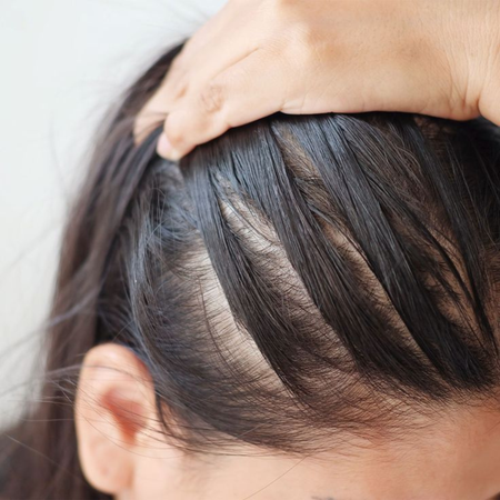 Receding Hairline