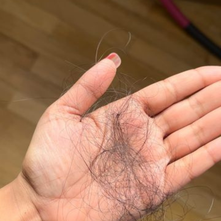 Hair Fall & Thinning